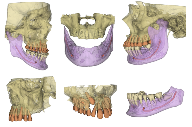 Sugarbot 3D segmentation preview